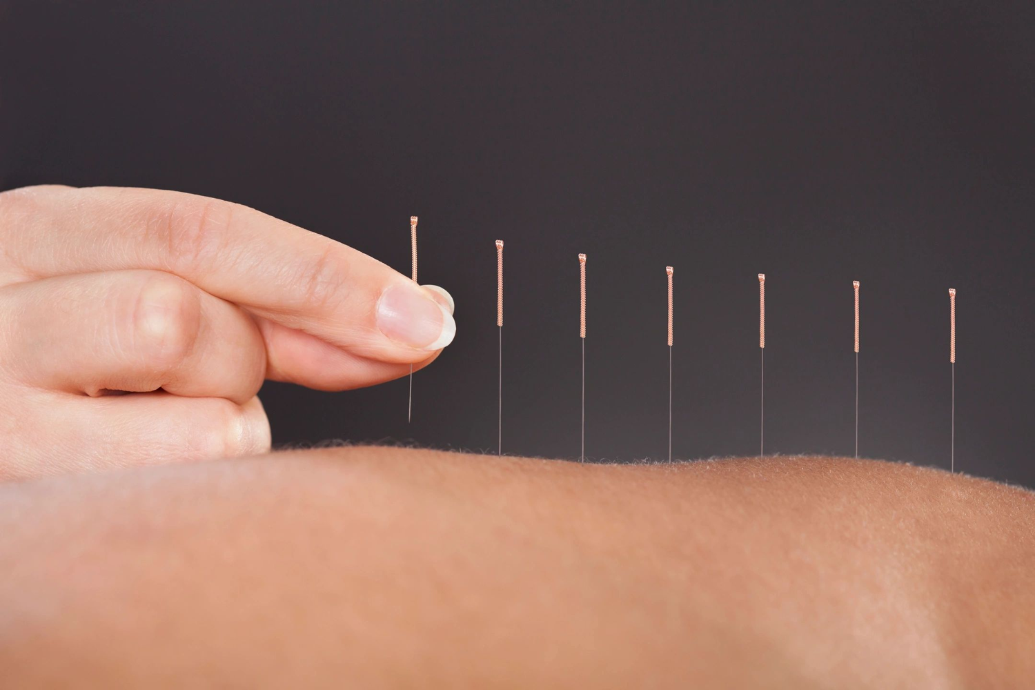 When is Acupuncture Recommended