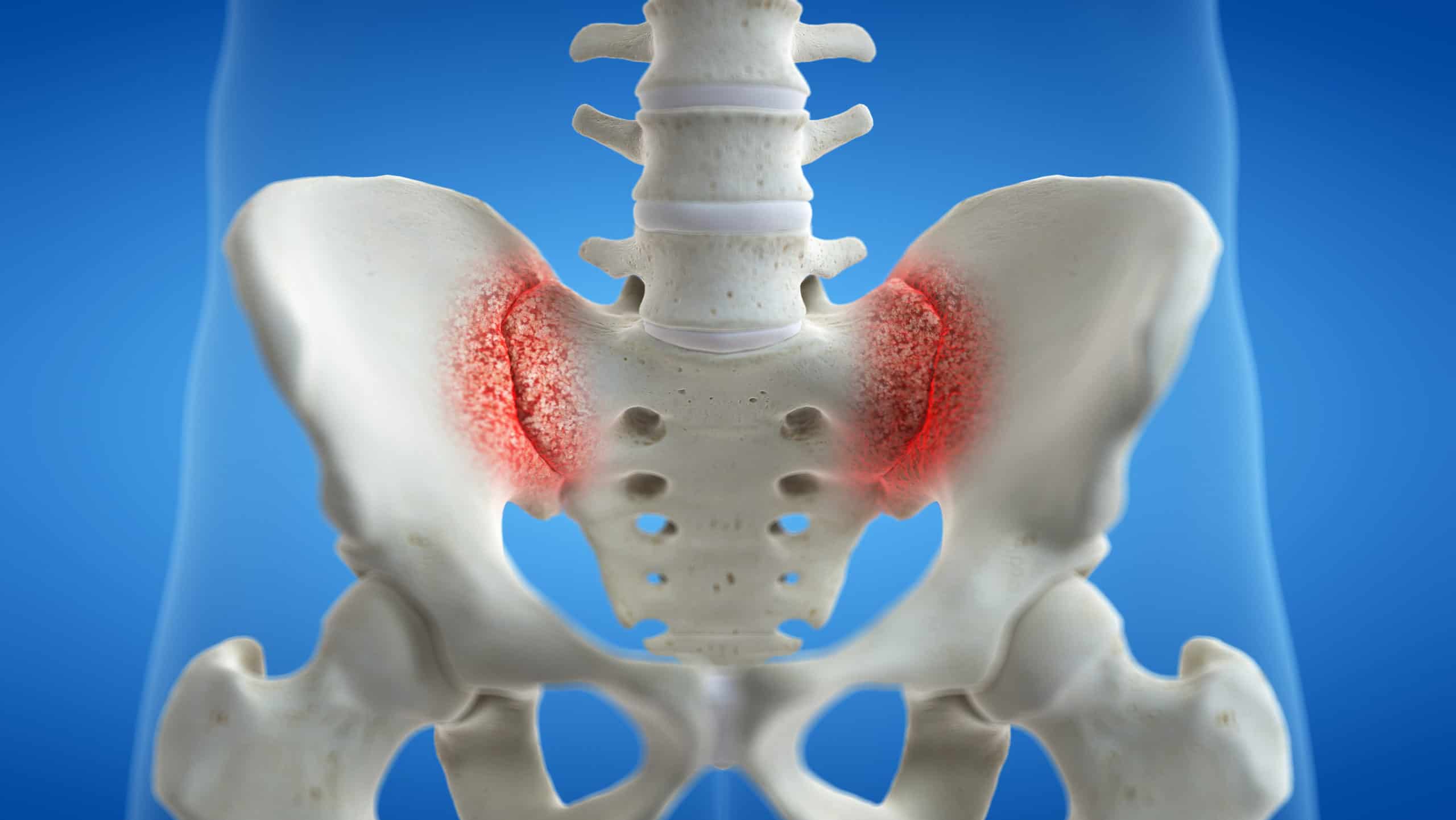 Sacroiliac Joint Injection - Northeast Spine and Sports Medicine