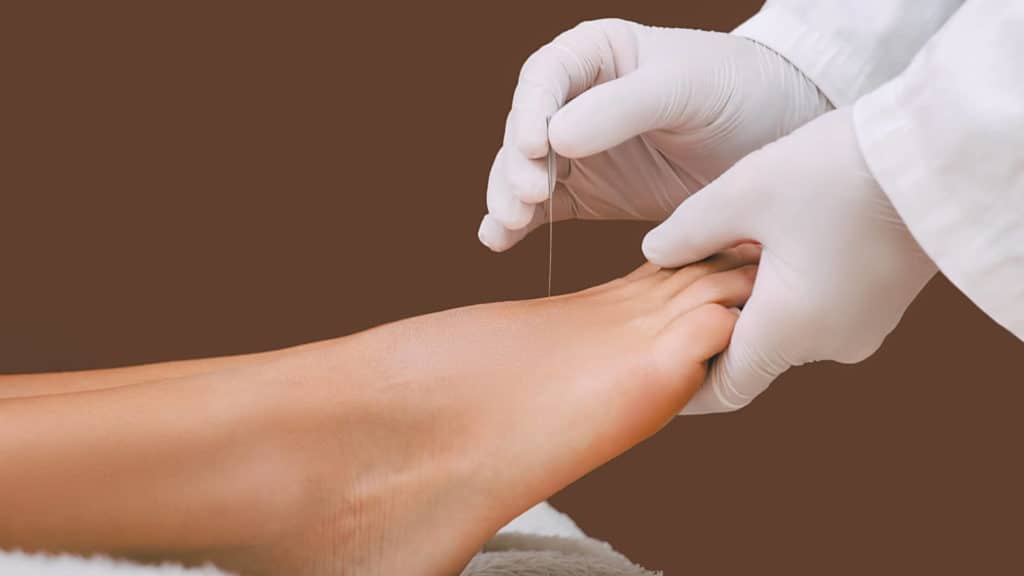 an acupuncturist performs the procedure on a human foot