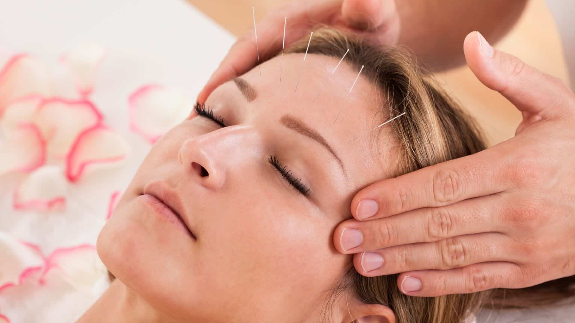 a patient undergoes acupuncture therapy on the face