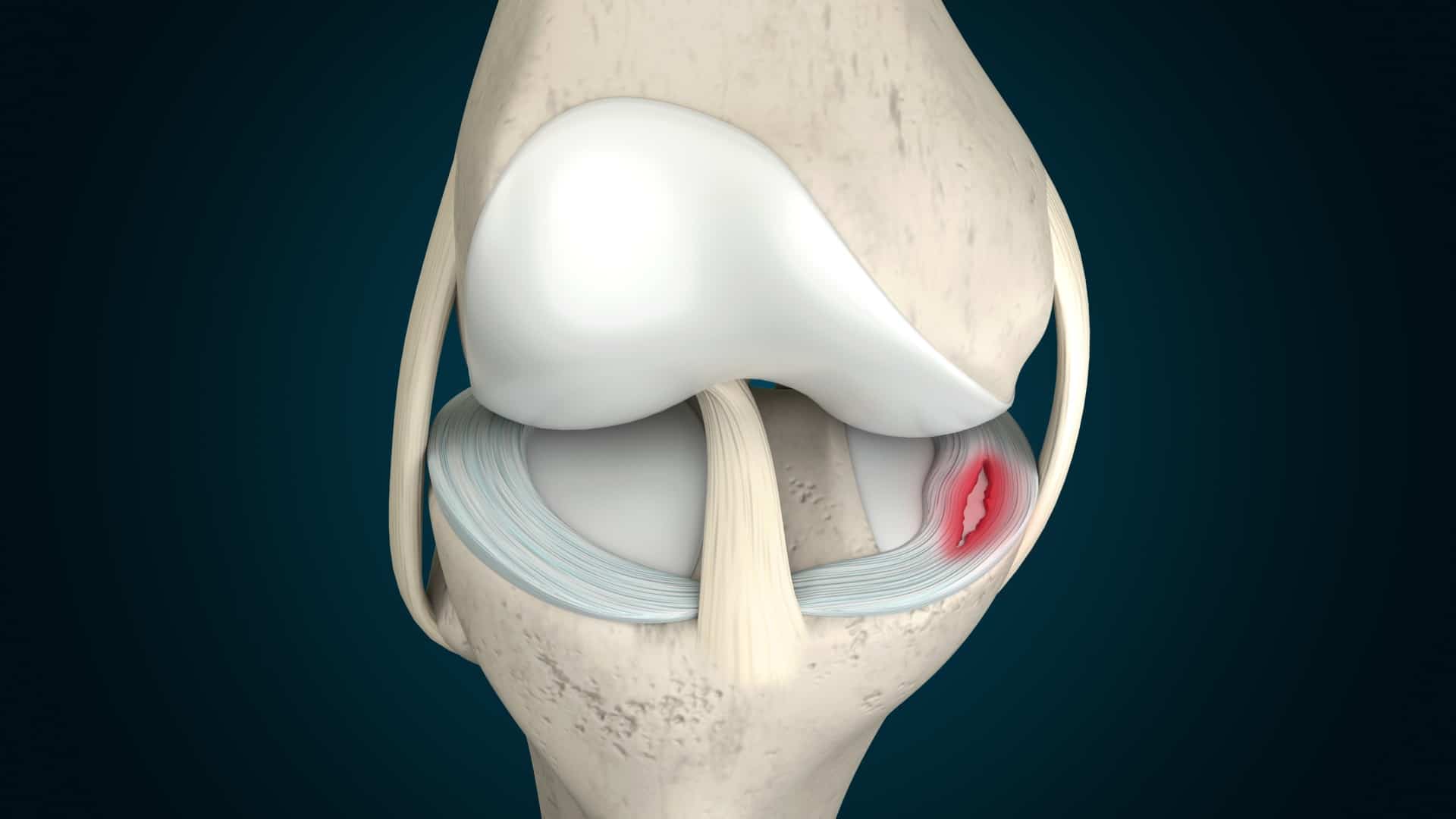 a 3D rendering of a meniscus tear