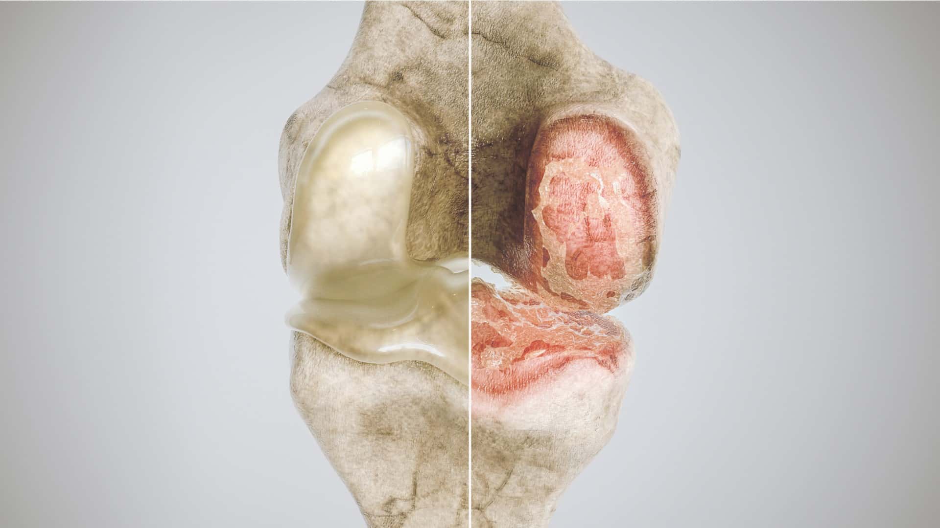 a normal knee vs a knee suffering from osteoarthritis