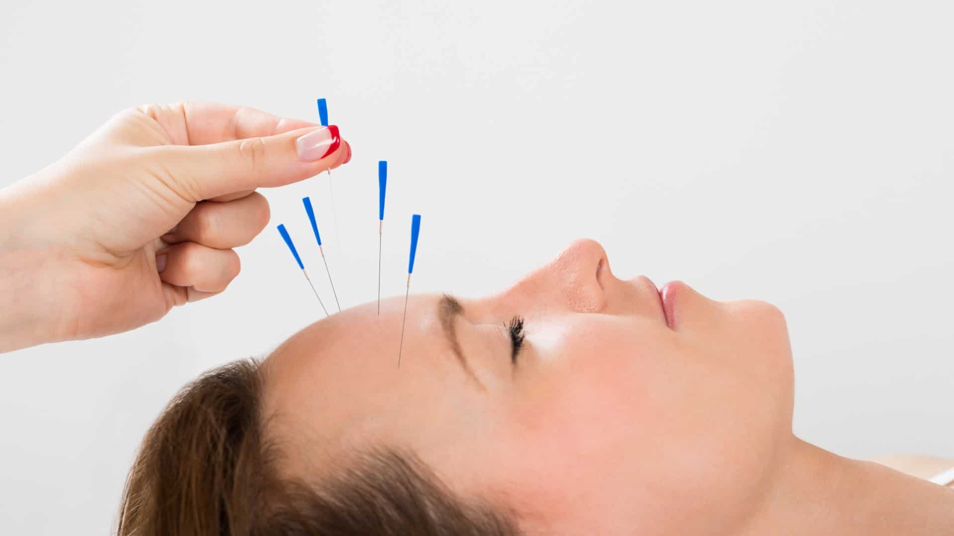 Patient gets acupuncture to treat their migraine | Acupuncture for Headaches and Migraines | NorthEast Spine and Sports Medicine