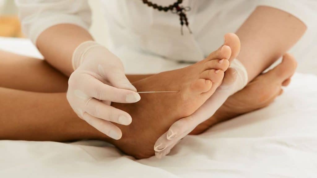 Close up of acupuncturist inserting needle into foot | Acupuncture for Back Pain at Northeast Spine and Sports Medicine