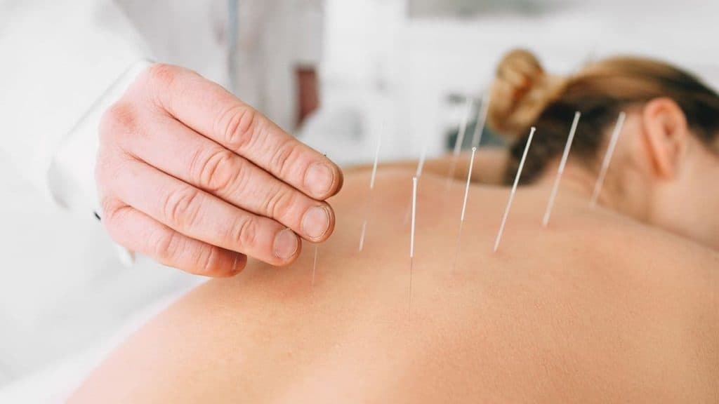 Close up of acupuncturist inserting needles into back | Acupuncture for Back Pain at Northeast Spine and Sports Medicine